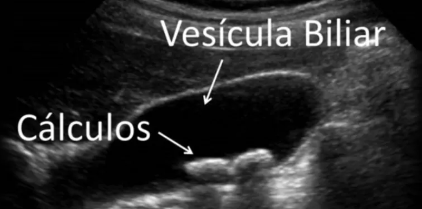 Como identificar pedra na vesícula biliar Dr. Gustavo Castro em Curitiba