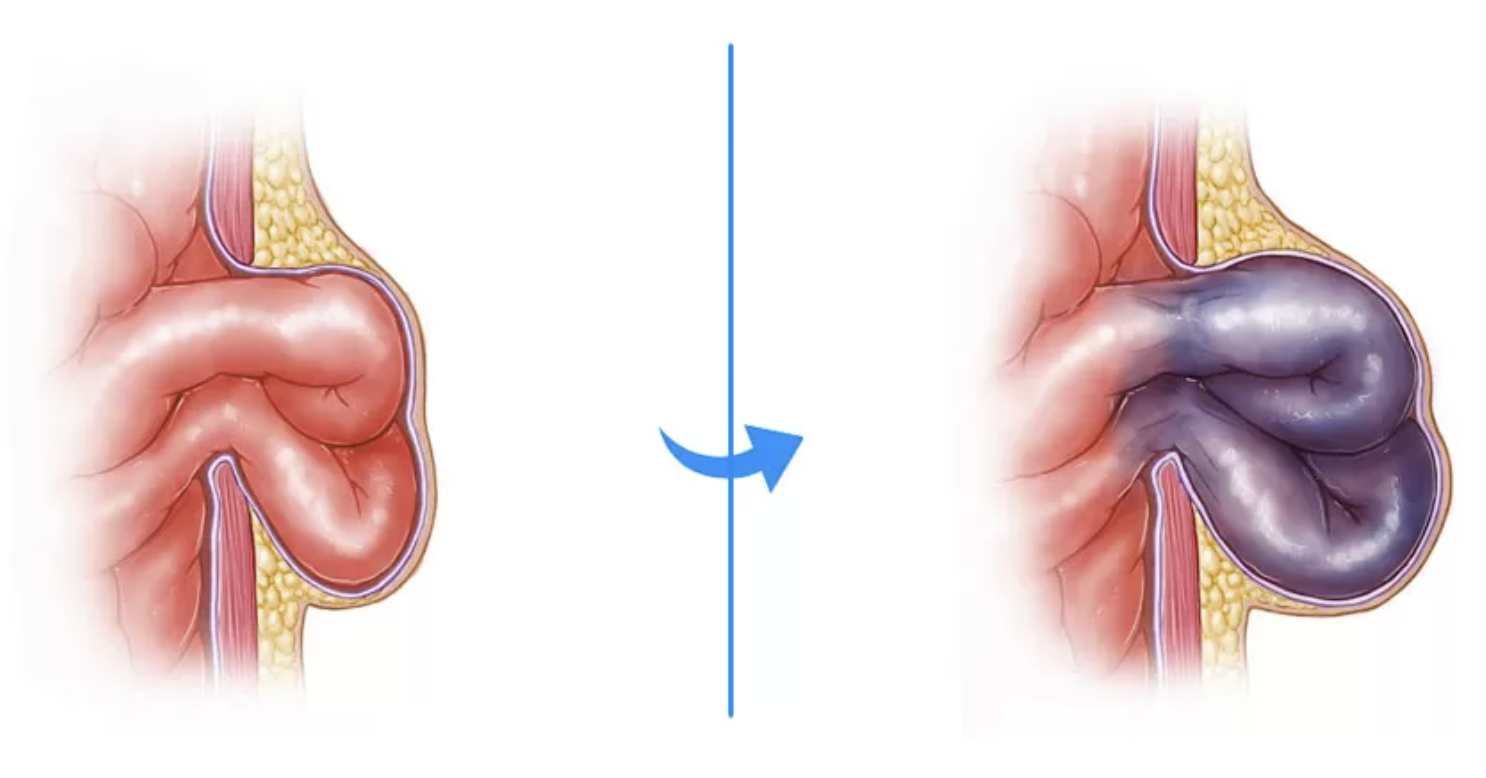 Encarceramento de hérnia de parede abdominal