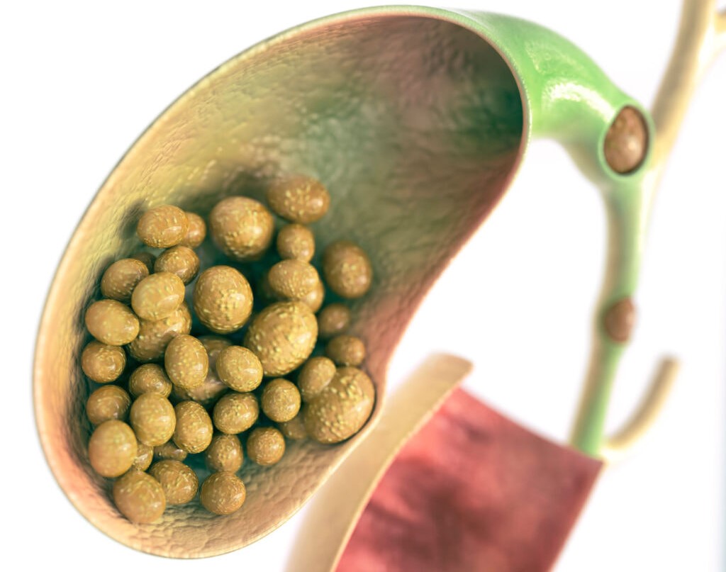 Pedras da Vesícula Biliar - Dr. Gustavo Castro