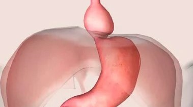 Doença do Refluxo e Hérnia de Hiato - Dr. Gustavo Castro