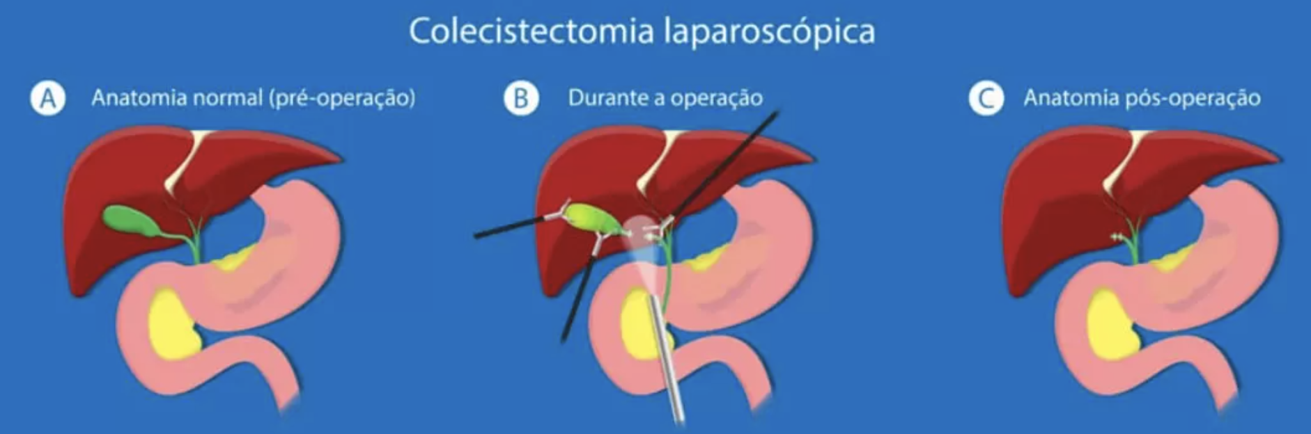 Tratamento de pedra na vesícula biliar