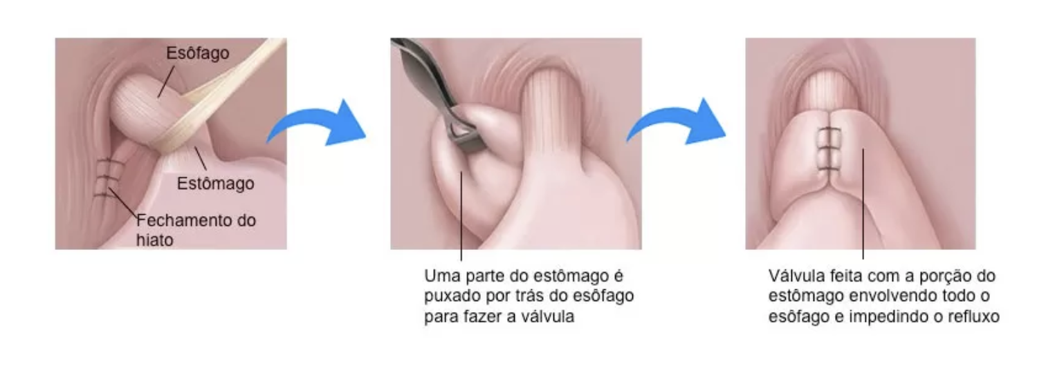 Doença do Refluxo e Hérnia de Hiato Dr. Gustavo Castro em Curitiba