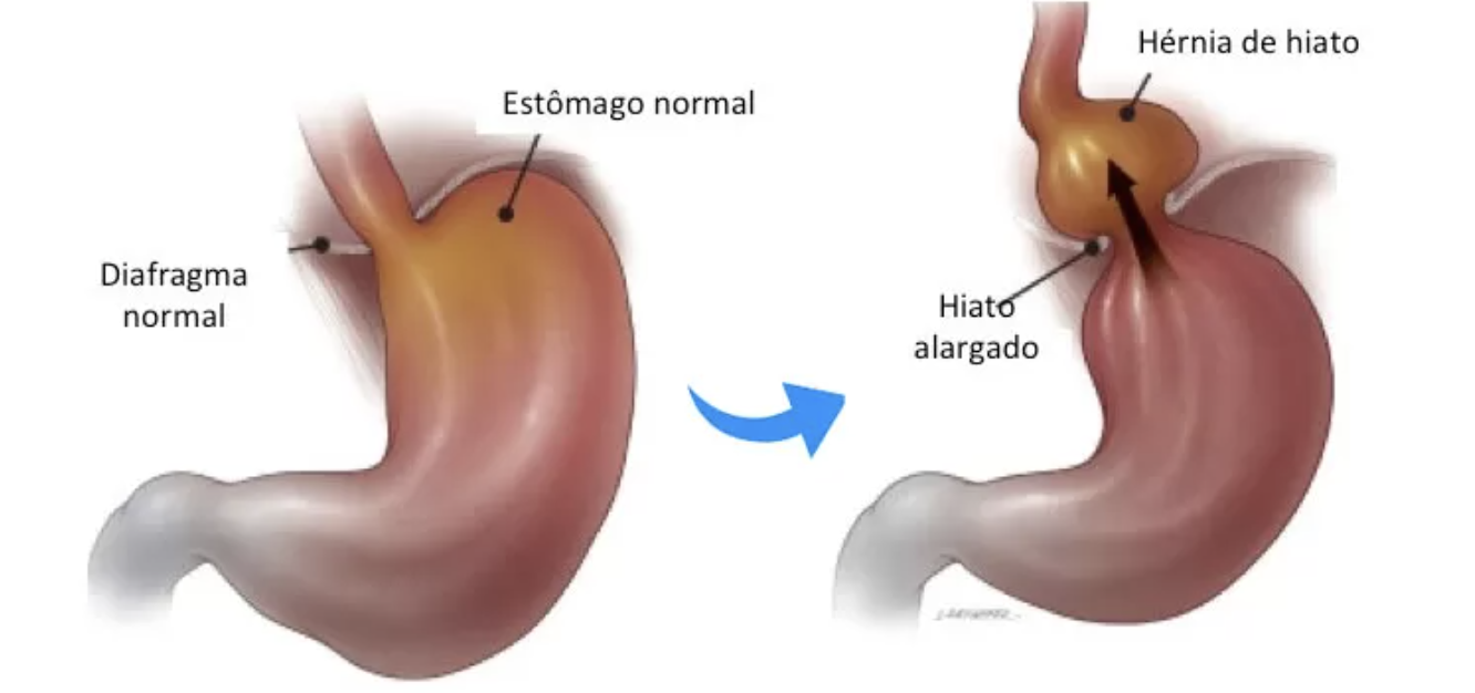Doença do Refluxo e Hérnia de Hiato Dr. Gustavo Castro em Curitiba